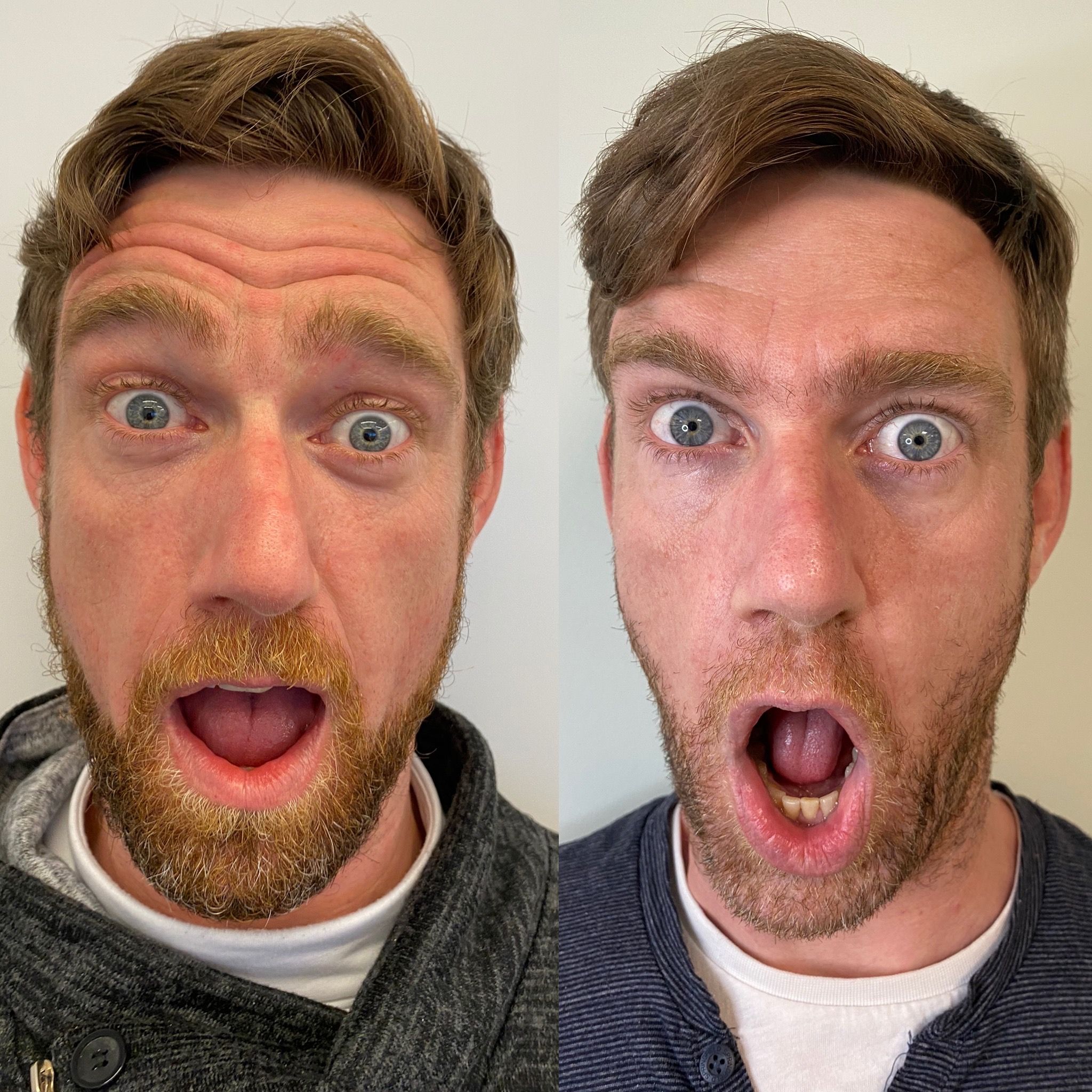 Botox y ácido hialurónico antes y después