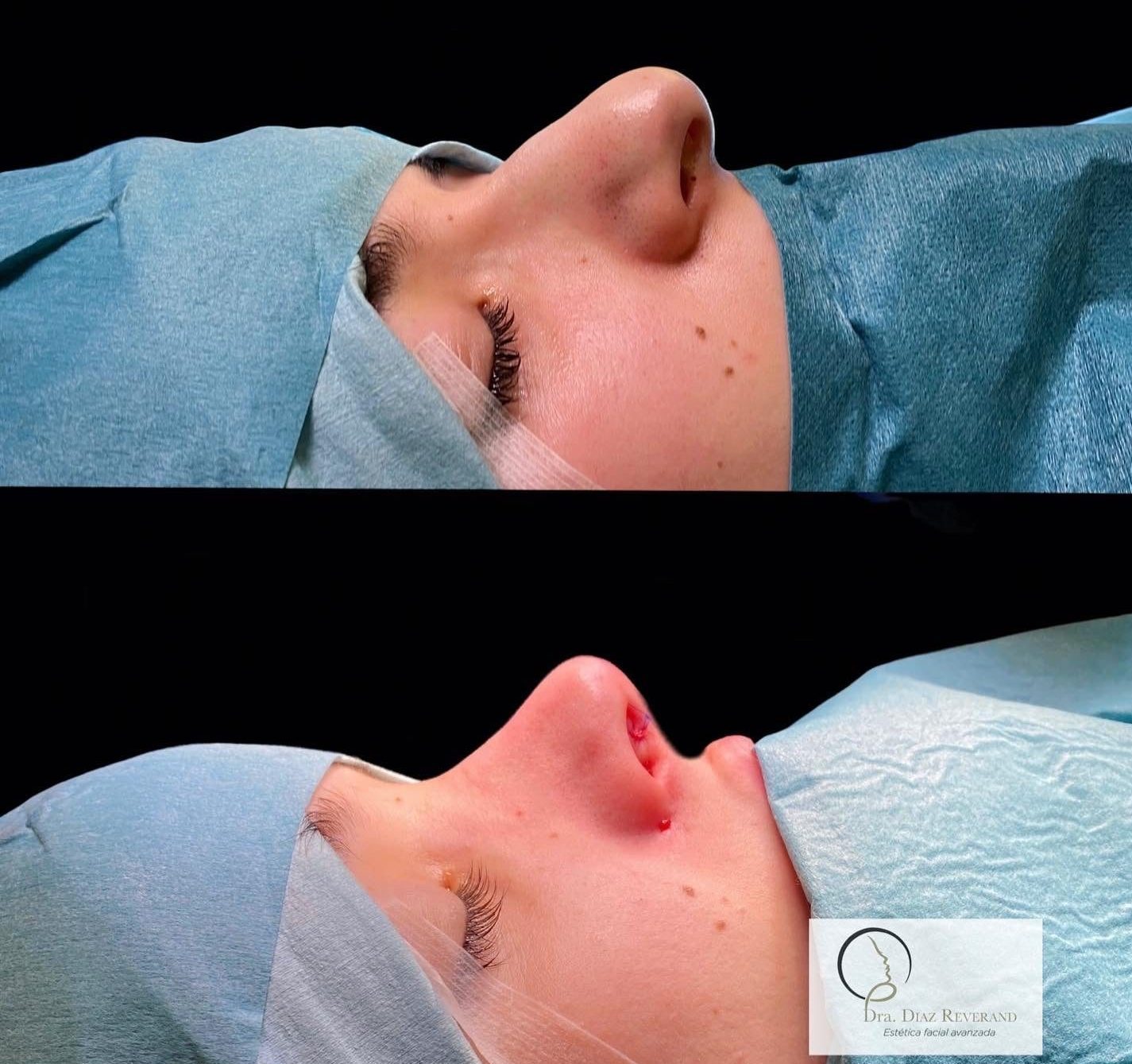 antes despues rinplastia ultrasónica barcelona susan diaz reverand