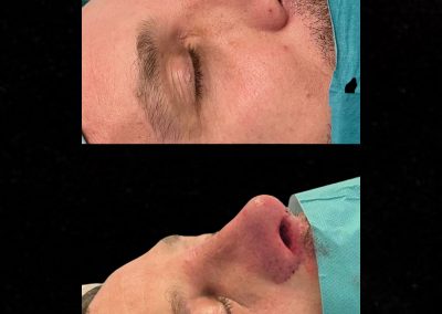 Hombre rinoplastia de revisión en carcas