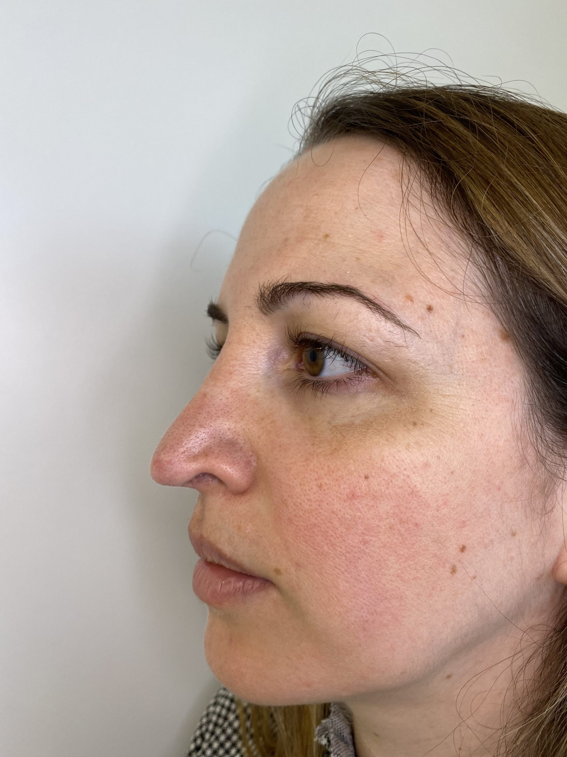 rinoplastia-secundaria-barcelona-susan Antes de rinoplastia secundaria barcelona