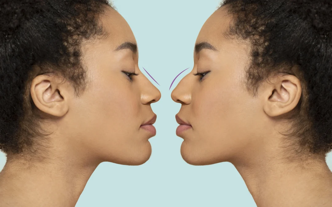 Rinoplastia Ultrasónica vs. Rinoplastia Tradicional