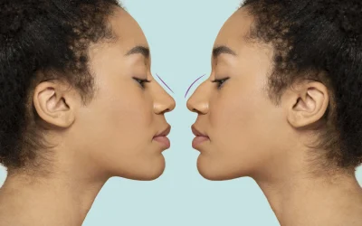 Rinoplastia Ultrasónica vs. Rinoplastia Tradicional