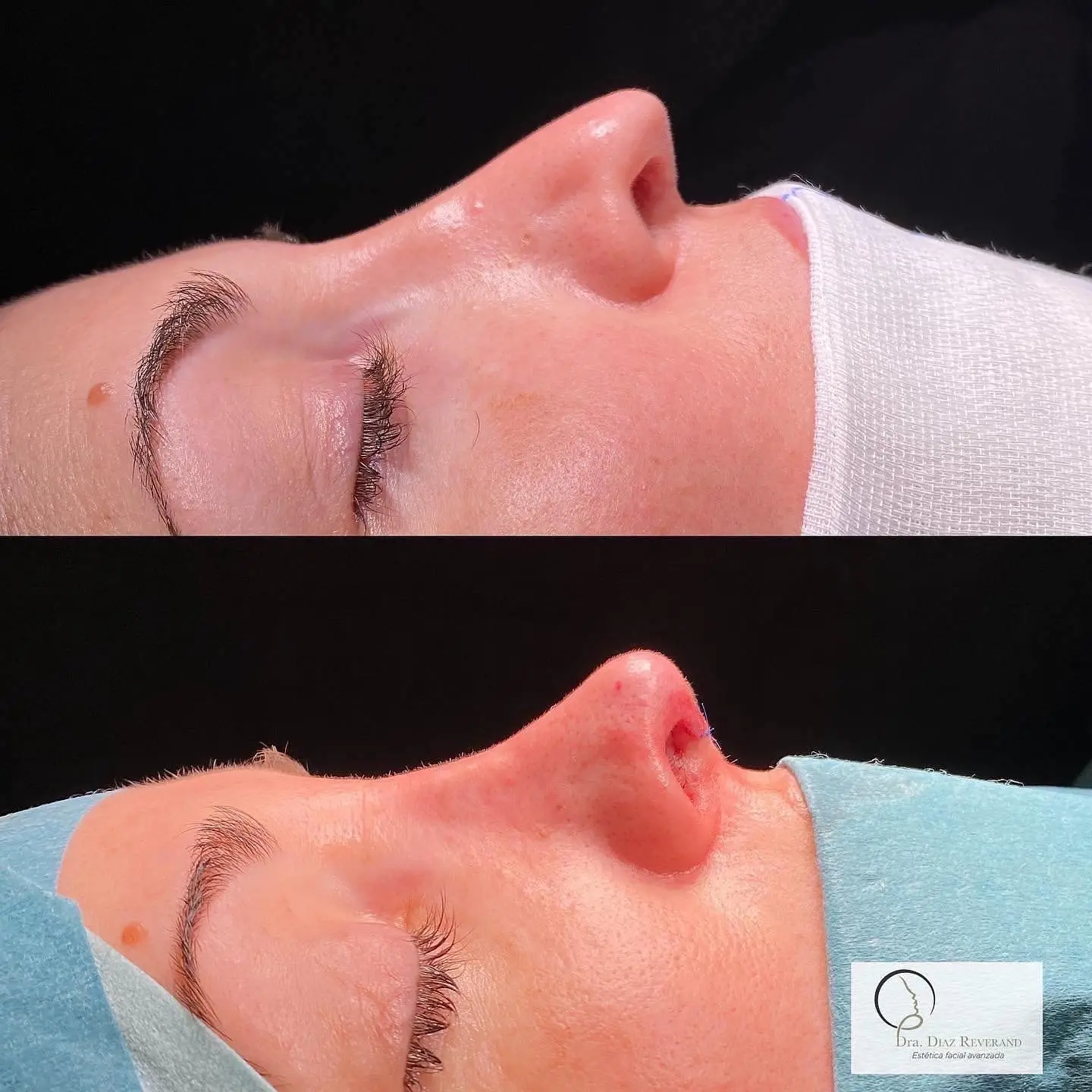 antes-despues-rinoplastia-susan-barcelona rinoplastia ultrasonica barcelona 2025 antes y despues