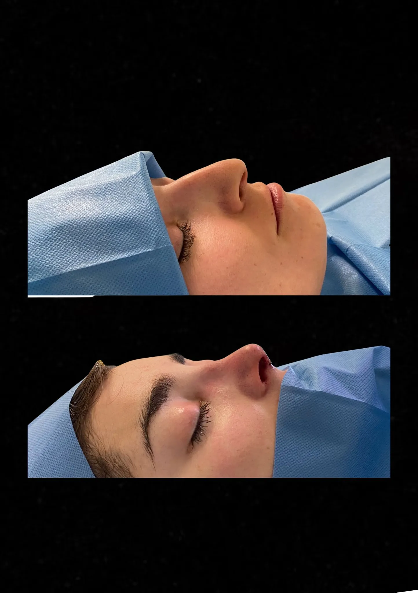 rinoplastia-ultrasónica-2025 rinoplastia ultrasonica en barcelona 2025