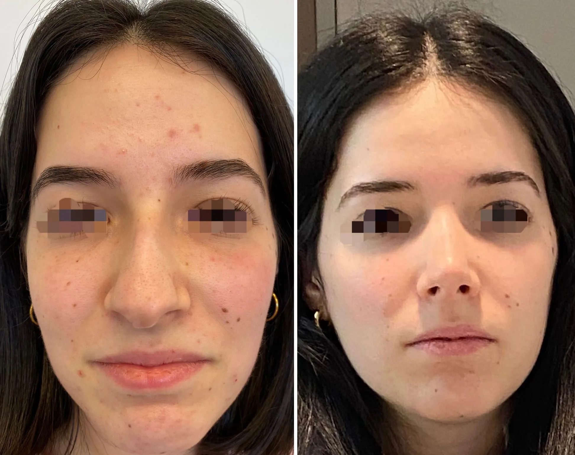 rinoplastia-ultrasonica-barcelona-2025 rinoplastia ultrasonica en barcelona antes y despues