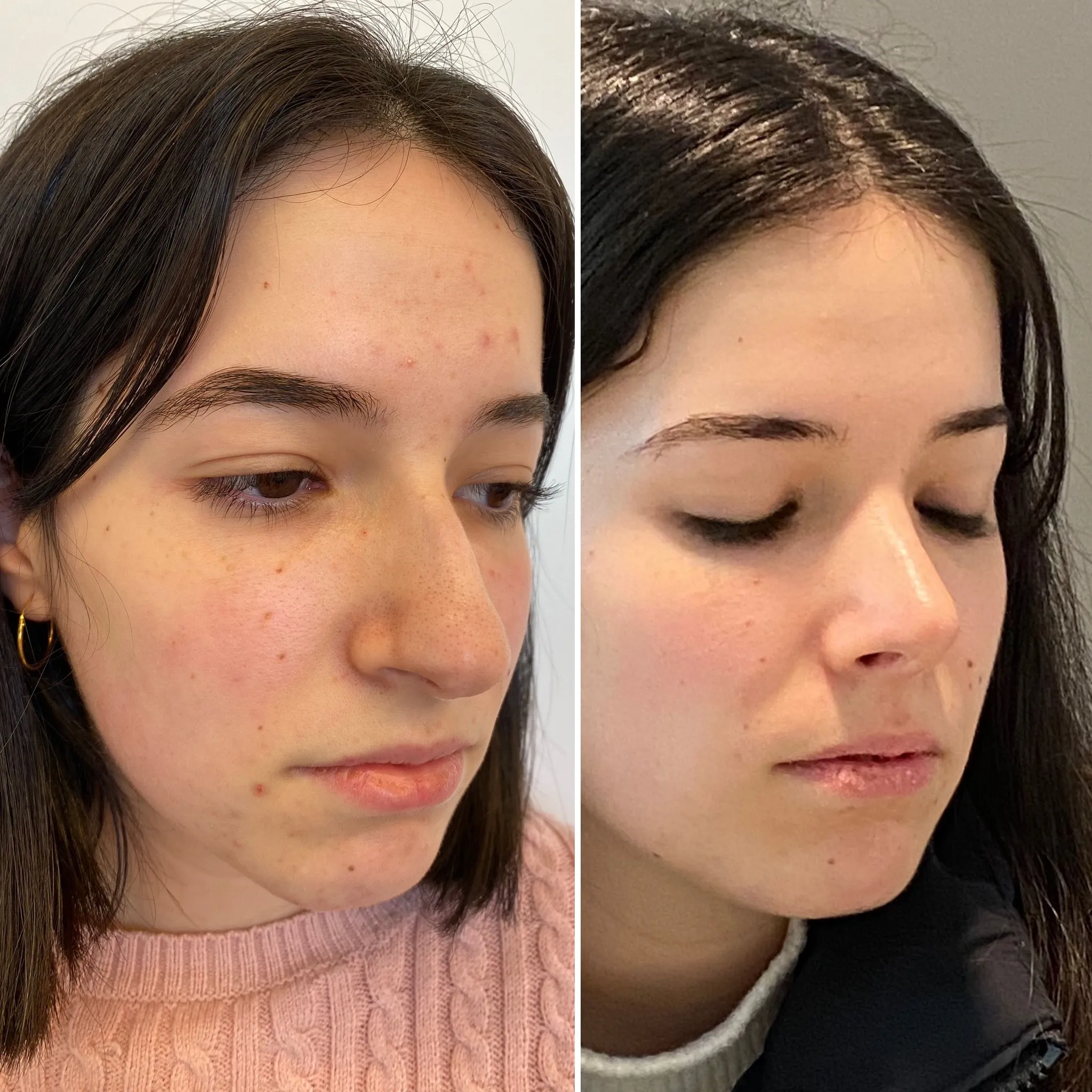 rinoplastia-ultrasonica-barcelona-susan-2025 rinoplastia ultrasonica cirugia 2025 en barcelona